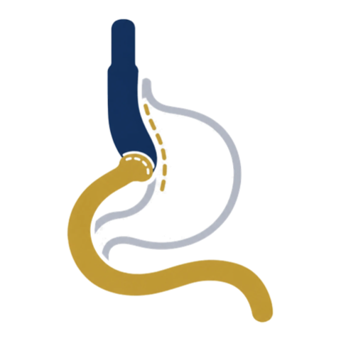 Ilustración esquemática del bypass gástrico de una sola anastomosis (BAGUA)