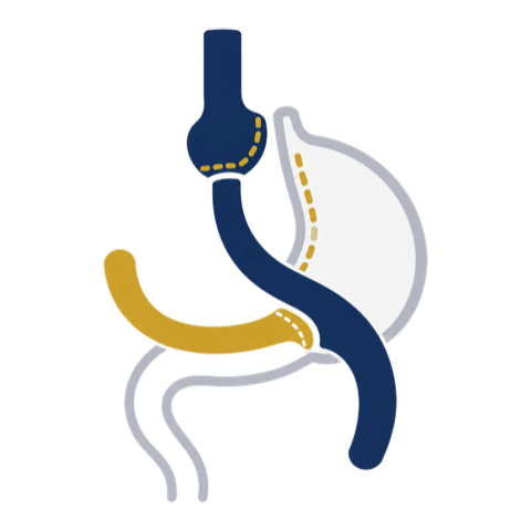 Ilustración esquemática del bypass gástrico en Y de Roux
