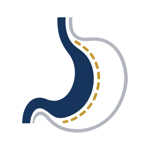 Ilustración esquemática de la manga gástrica